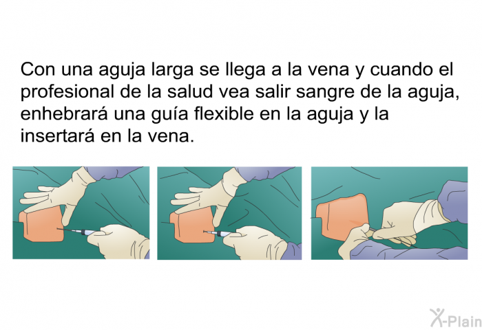 Con una aguja larga se llega a la vena y cuando el profesional de la salud vea salir sangre de la aguja, enhebrar una gua flexible en la aguja y la insertar en la vena.