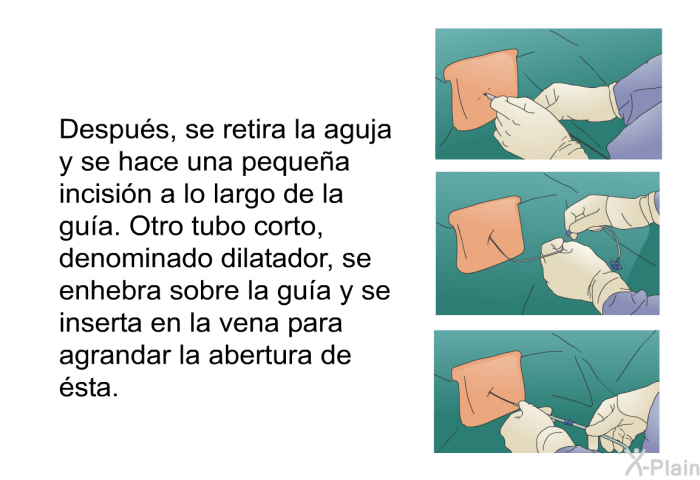 Despus, se retira la aguja y se hace una pequea incisin a lo largo de la gua. Otro tubo corto, denominado dilatador, se enhebra sobre la gua y se inserta en la vena para agrandar la abertura de sta.