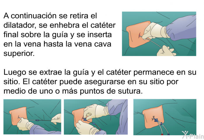 A continuacin se retira el dilatador, se enhebra el catter final sobre la gua y se inserta en la vena hasta la vena cava superior. Luego se extrae la gua y el catter permanece en su sitio. El catter puede asegurarse en su sitio por medio de uno o ms puntos de sutura.