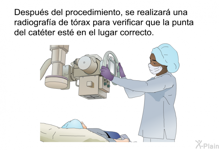 Despus del procedimiento, se realizar una radiografa de trax para verificar que la punta del catter est en el lugar correcto.