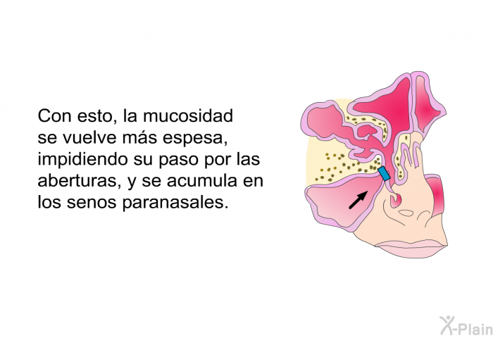 Con esto, la mucosidad se vuelve ms espesa, impidiendo su paso por las aberturas, y se acumula en los senos paranasales.