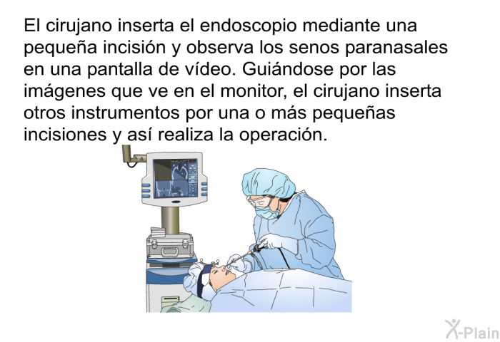 El cirujano inserta el endoscopio mediante una pequea incisin y observa los senos paranasales en una pantalla de vdeo. Guindose por las imgenes que ve en el monitor, el cirujano inserta otros instrumentos por una o ms pequeas incisiones y as realiza la operacin.