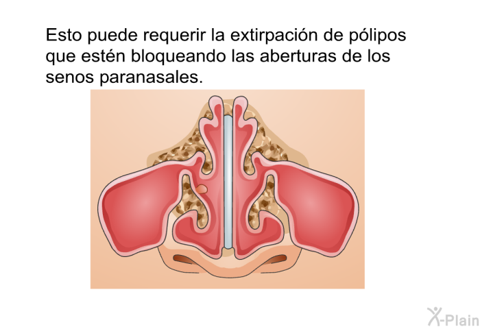 Esto puede requerir la extirpacin de plipos que estn bloqueando las aberturas de los senos paranasales.