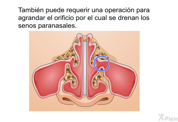 Tambin puede requerir una operacin para agrandar el orificio por el cual se drenan los senos paranasales.