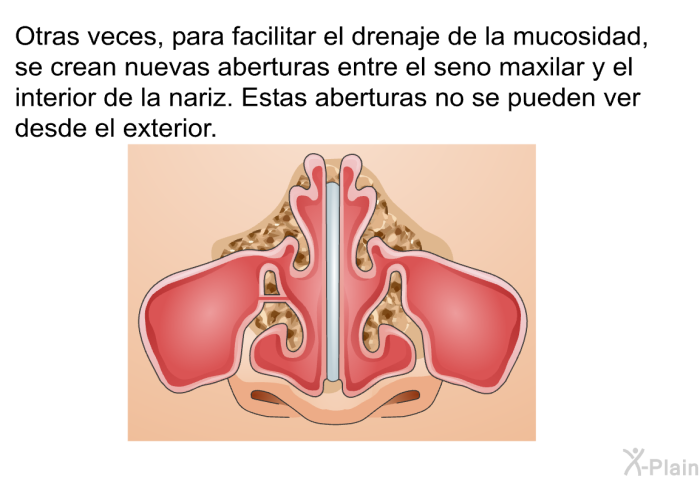 Otras veces, para facilitar el drenaje de la mucosidad, se crean nuevas aberturas entre el seno maxilar y el interior de la nariz. Estas aberturas no se pueden ver desde el exterior.