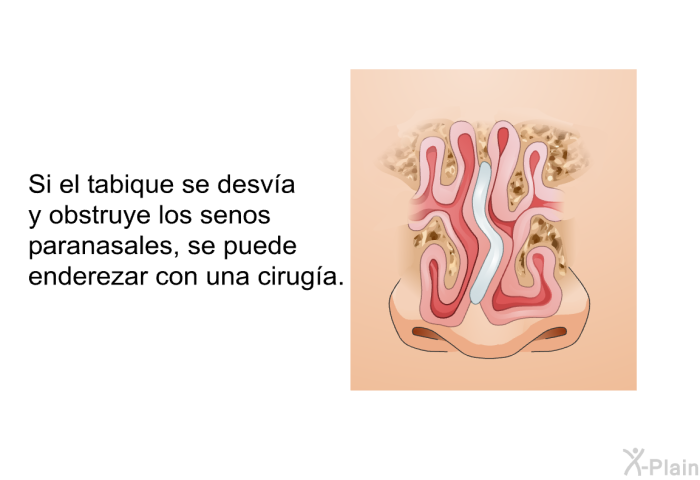 Si el tabique se desva y obstruye los senos paranasales, se puede enderezar con una ciruga.