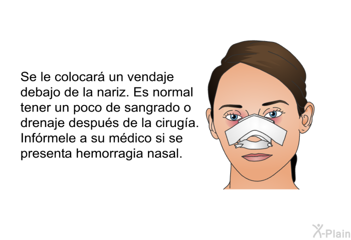 Se le colocar un vendaje debajo de la nariz. Es normal tener un poco de sangrado o drenaje despus de la ciruga. Infrmele a su mdico si se presenta hemorragia nasal.