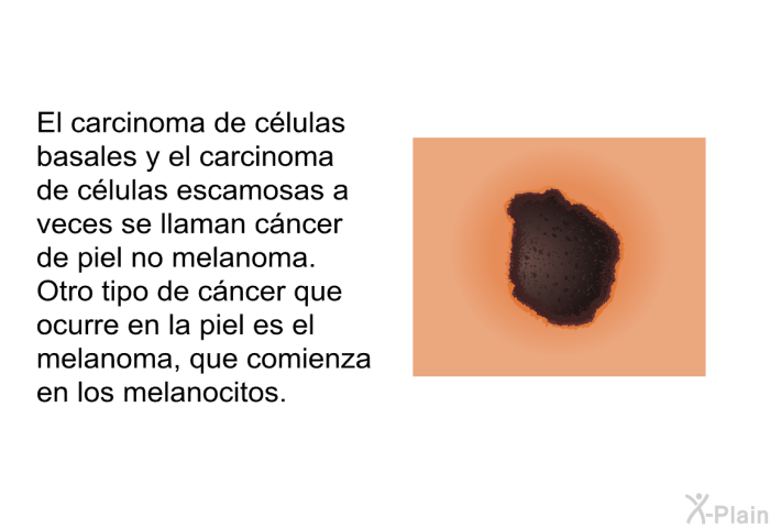 El carcinoma de clulas basales y el carcinoma de clulas escamosas a veces se llaman<I> </I>cncer de piel <I>no melanoma</I>. Otro tipo de cncer que ocurre en la piel es el melanoma, que comienza en los melanocitos.