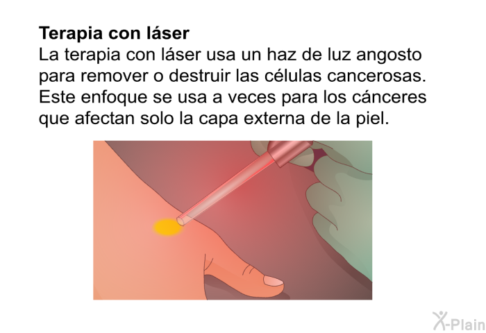 <B>Terapia con lser:</B> La terapia con lser usa un haz de luz angosto para remover o destruir las clulas cancerosas. Este enfoque se usa a veces para los cnceres que afectan solo la capa externa de la piel.