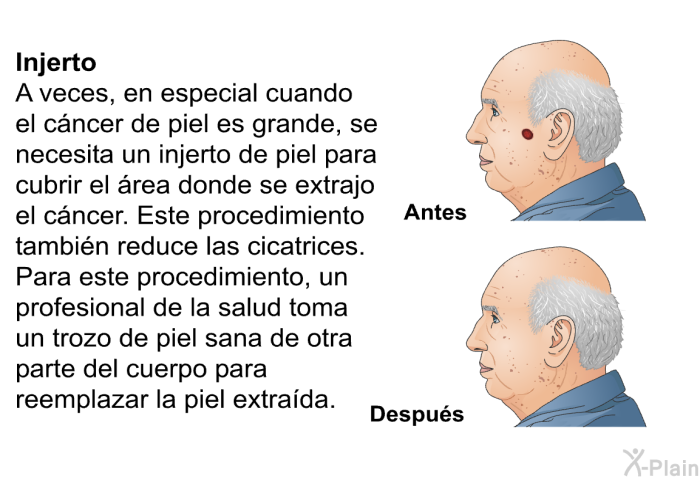 <B>Injerto:</B> A veces, en especial cuando el cncer de piel es grande, se necesita un injerto de piel para cubrir el rea donde se extrajo el cncer. Este procedimiento tambin reduce las cicatrices. Para este procedimiento, un profesional de la salud toma un trozo de piel sana de otra parte del cuerpo para reemplazar la piel extrada.