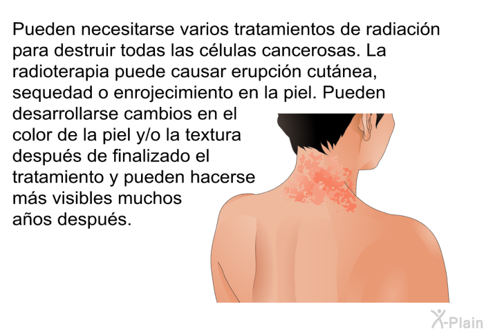 Pueden necesitarse varios tratamientos de radiacin para destruir todas las clulas cancerosas. La radioterapia puede causar erupcin cutnea, sequedad o enrojecimiento en la piel. Pueden desarrollarse cambios en el color de la piel y/o la textura despus de finalizado el tratamiento y pueden hacerse ms visibles muchos aos despus.