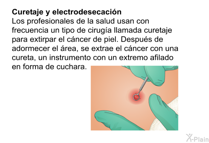 <B>Curetaje y electrodesecacin:</B> Los profesionales de la salud usan con frecuencia un tipo de ciruga llamada <I>curetaje</I> para extirpar el cncer de piel. Despus de adormecer el rea, se extrae el cncer con una cureta, un instrumento con un extremo afilado en forma de cuchara.
