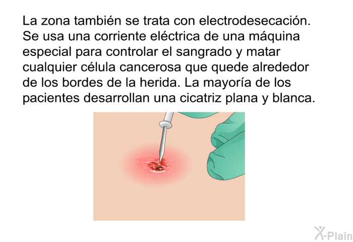 La zona tambin se trata con electrodesecacin. Se usa una corriente elctrica de una mquina especial para controlar el sangrado y matar cualquier clula cancerosa que quede alrededor de los bordes de la herida. La mayora de los pacientes desarrollan una cicatriz plana y blanca.