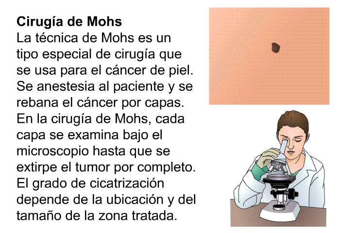 <B>Ciruga de Mohs:</B> La tcnica de Mohs es un tipo especial de ciruga que se usa para el cncer de piel. Se anestesia al paciente y se rebana el cncer por capas. En la ciruga de Mohs, cada capa se examina bajo el microscopio hasta que se extirpe el tumor por completo. El grado de cicatrizacin depende de la ubicacin y del tamao de la zona tratada.