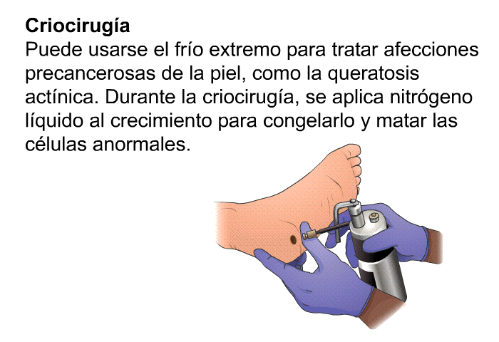 <B>Criociruga:</B> Puede usarse el fro extremo para tratar afecciones precancerosas de la piel, como la queratosis actnica. Durante la criociruga, se aplica nitrgeno lquido al crecimiento para congelarlo y matar las clulas anormales.