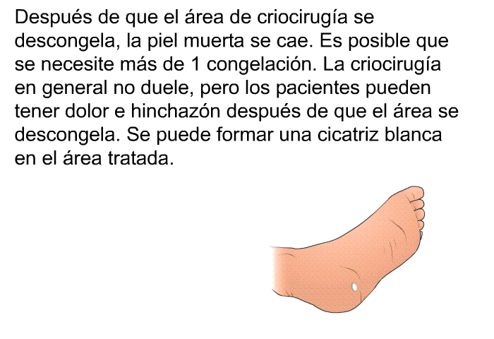Despus de que el rea de criociruga se descongela, la piel muerta se cae. Es posible que se necesite ms de 1 congelacin. La criociruga en general no duele, pero los pacientes pueden tener dolor e hinchazn despus de que el rea se descongela. Se puede formar una cicatriz blanca en el rea tratada.
