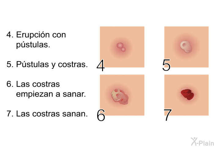 Erupcin con pstulas. Pstulas y costras. Las costras empiezan a sanar. Las costras sanan.