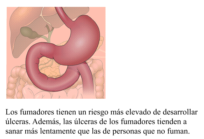 Los fumadores tienen un riesgo ms elevado de desarrollar lceras. Adems, las lceras de los fumadores tienden a sanar ms lentamente que las de personas que no fuman.