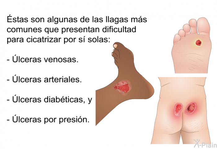 Éstas son algunas de las llagas ms comunes que presentan dificultad para cicatrizar por s solas:  Úlceras venosas. Úlceras arteriales. Úlceras diabticas, y Úlceras por presin.