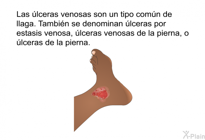 Las lceras venosas son un tipo comn de llaga. Tambin se denominan lceras por estasis venosa, lceras venosas de la pierna, o lceras de la pierna.