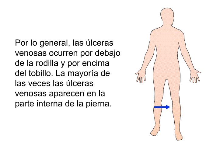 Por lo general, las lceras venosas ocurren por debajo de la rodilla y por encima del tobillo. La mayora de las veces las lceras venosas aparecen en la parte interna de la pierna.