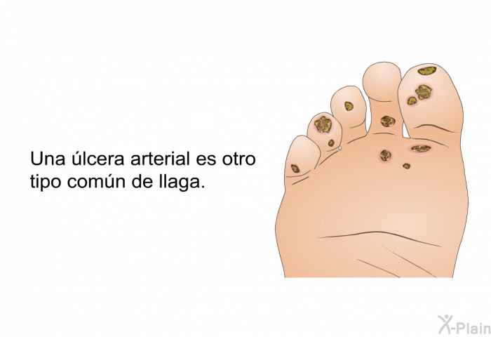 Una lcera arterial es otro tipo comn de llaga.