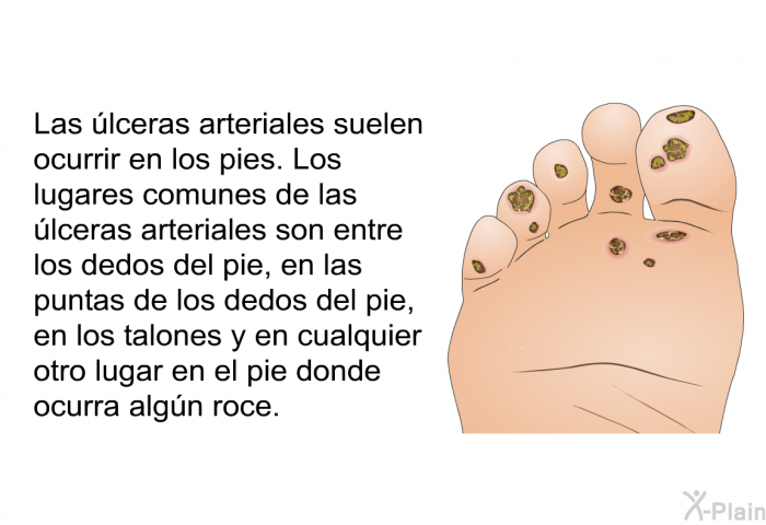 Las lceras arteriales suelen ocurrir en los pies. Los lugares comunes de las lceras arteriales son entre los dedos del pie, en las puntas de los dedos del pie, en los talones y en cualquier otro lugar en el pie donde ocurra algn roce.