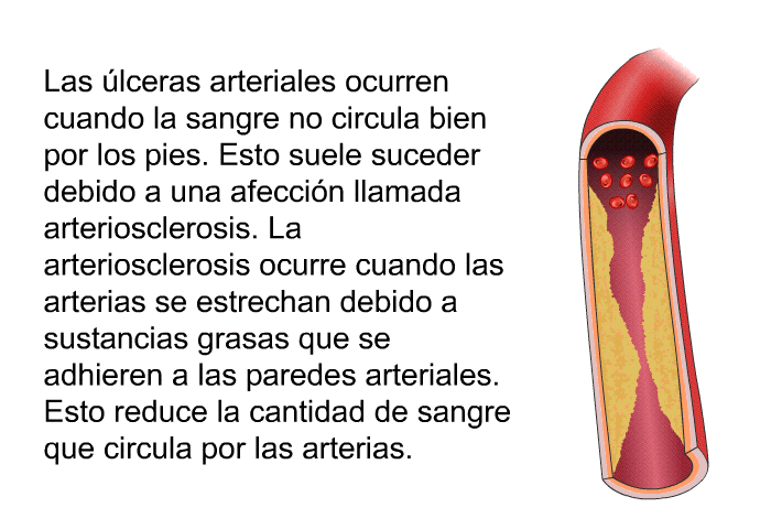 Las lceras arteriales ocurren cuando la sangre no circula bien por los pies. Esto suele suceder debido a una afeccin llamada arteriosclerosis. La arteriosclerosis ocurre cuando las arterias se estrechan debido a sustancias grasas que se adhieren a las paredes arteriales. Esto reduce la cantidad de sangre que circula por las arterias.