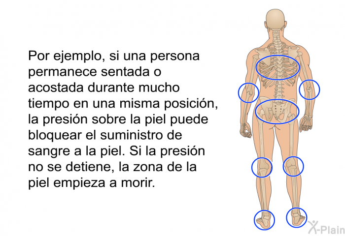 Por ejemplo, si una persona permanece sentada o acostada durante mucho tiempo en una misma posici�n, la presi�n sobre la piel puede bloquear el suministro de sangre a la piel. Si la presi�n no se detiene, la zona de la piel empieza a morir.