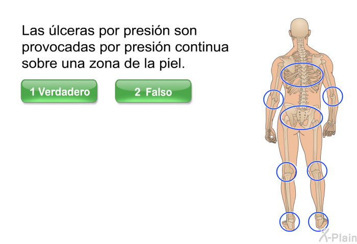 Las �lceras por presi�n son provocadas por presi�n continua sobre una zona de la piel.