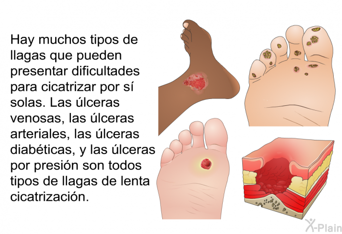 Hay muchos tipos de llagas que pueden presentar dificultades para cicatrizar por s solas. Las lceras venosas, las lceras arteriales, las lceras diabticas, y las lceras por presin son todos tipos de llagas de lenta cicatrizacin.