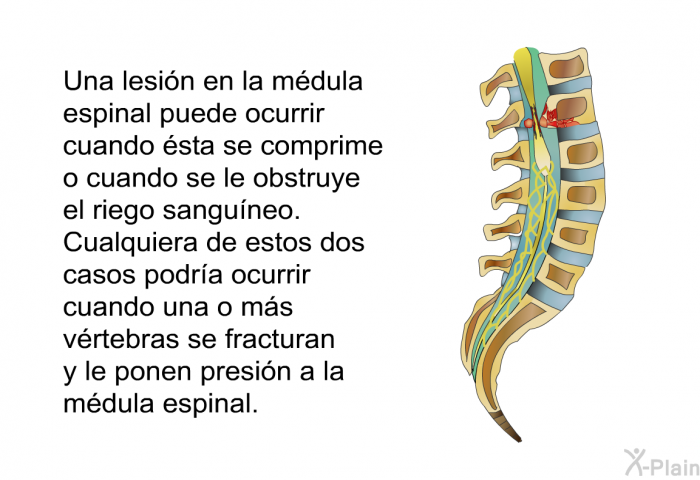 Una lesin en la mdula espinal puede ocurrir cuando sta se comprime o cuando se le obstruye el riego sanguneo. Cualquiera de estos dos casos podra ocurrir cuando una o ms vrtebras se fracturan y le ponen presin a la mdula espinal.