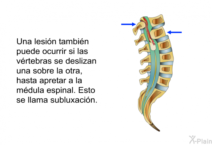 Una lesin tambin puede ocurrir si las vrtebras se deslizan una sobre la otra, hasta apretar a la mdula espinal. Esto se llama <I>subluxacin</I>.