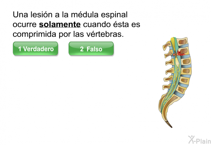 Una lesin a la mdula espinal ocurre <U><B>solamente</B></U> cuando sta es comprimida por las vrtebras.