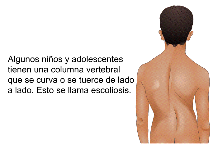 Algunos nios y adolescentes tienen una columna vertebral que se curva o se tuerce de lado a lado. Esto se llama escoliosis.