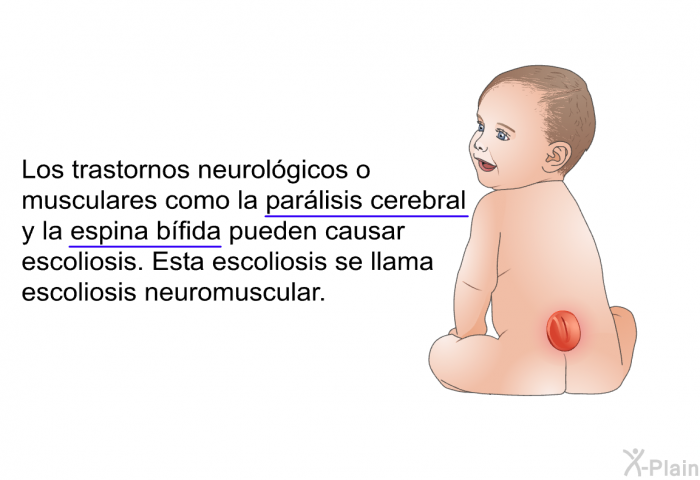 Los trastornos neurolgicos o musculares como la parlisis cerebral y la espina bfida pueden causar escoliosis. Esta escoliosis se llama escoliosis neuromuscular.