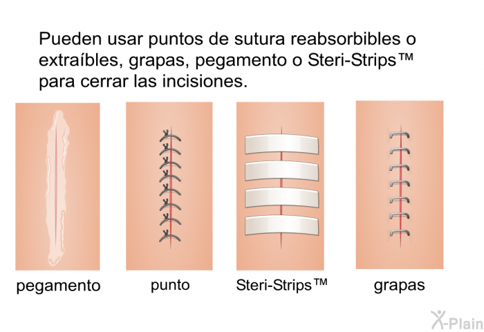 Pueden usar puntos de sutura reabsorbibles o extra�bles, grapas, pegamento o Steri-Strips&trade; para cerrar las incisiones.