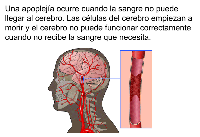 Una apopleja ocurre cuando la sangre no puede llegar al cerebro. Las clulas del cerebro empiezan a morir y el cerebro no puede funcionar correctamente cuando no recibe la sangre que necesita.