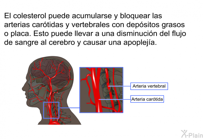 El colesterol puede acumularse y bloquear las arterias cartidas y vertebrales con depsitos grasos o placa. Esto puede llevar a una disminucin del flujo de sangre al cerebro y causar una apopleja.