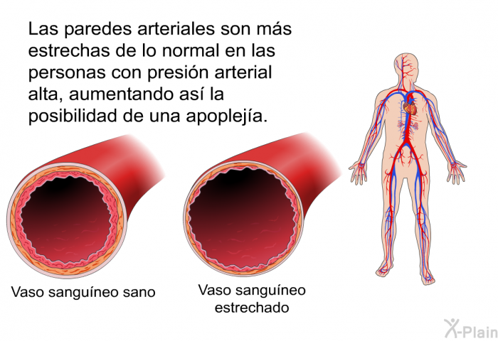 Las paredes arteriales son ms estrechas de lo normal en las personas con presin arterial alta, aumentando as la posibilidad de una apopleja.