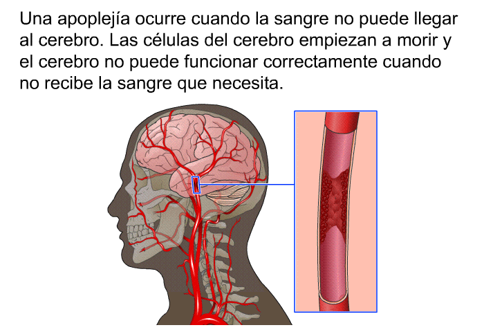 Una apopleja ocurre cuando la sangre no puede llegar al cerebro. Las clulas del cerebro empiezan a morir y el cerebro no puede funcionar correctamente cuando no recibe la sangre que necesita.
