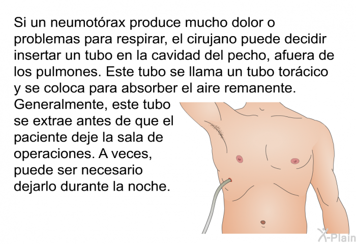Si un neumotrax produce mucho dolor o problemas para respirar, el cirujano puede decidir insertar un tubo en la cavidad del pecho, afuera de los pulmones. Este tubo se llama un tubo torcico y se coloca para absorber el aire remanente. Generalmente, este tubo se extrae antes de que el paciente deje la sala de operaciones. A veces, puede ser necesario dejarlo durante la noche.