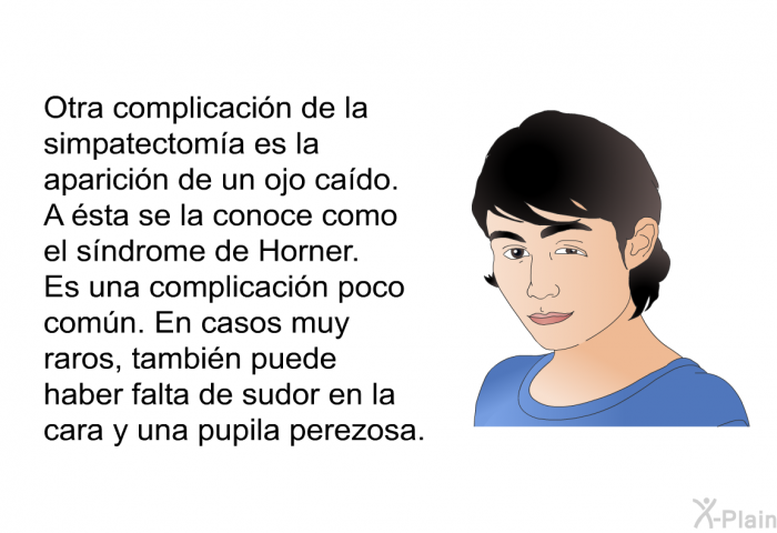 Otra complicacin de la simpatectoma es la aparicin de un ojo cado. A sta se la conoce como el sndrome de Horner. Es una complicacin poco comn. En casos muy raros, tambin puede haber falta de sudor en la cara y una pupila perezosa.