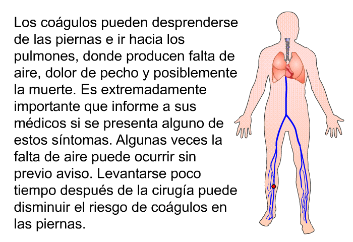 Los cogulos pueden desprenderse de las piernas e ir hacia los pulmones, donde producen falta de aire, dolor de pecho y posiblemente la muerte. Es extremadamente importante que informe a sus mdicos si se presenta alguno de estos sntomas. Algunas veces la falta de aire puede ocurrir sin previo aviso. Levantarse poco tiempo despus de la ciruga puede disminuir el riesgo de cogulos en las piernas.