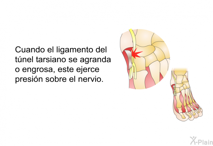 Cuando el ligamento del tnel tarsiano se agranda o engrosa, este ejerce presin sobre el nervio.