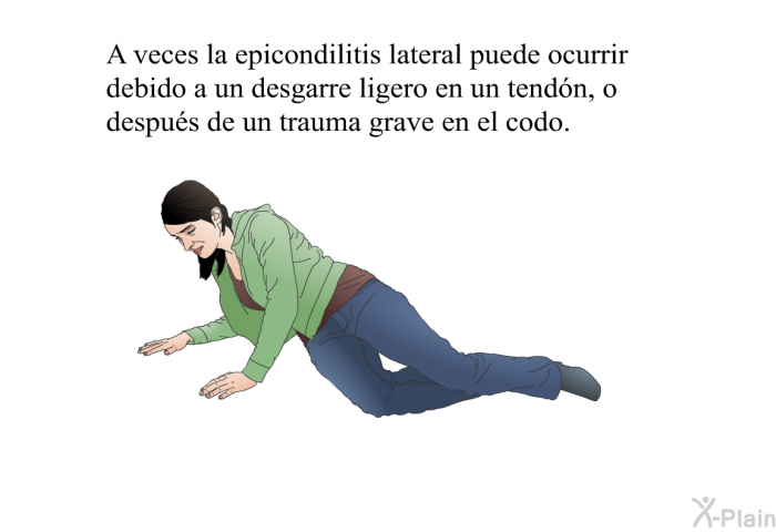 A veces la epicondilitis lateral puede ocurrir debido a un desgarre ligero en un tendn, o despus de un trauma grave en el codo.