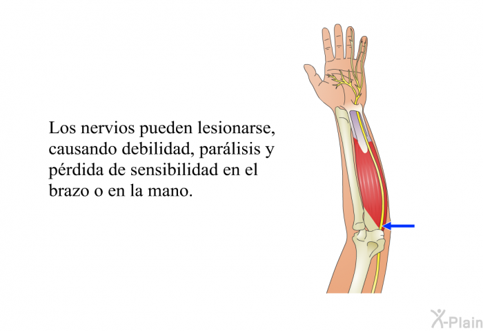 Los nervios pueden lesionarse, causando debilidad, parlisis y prdida de sensibilidad en el brazo o en la mano.