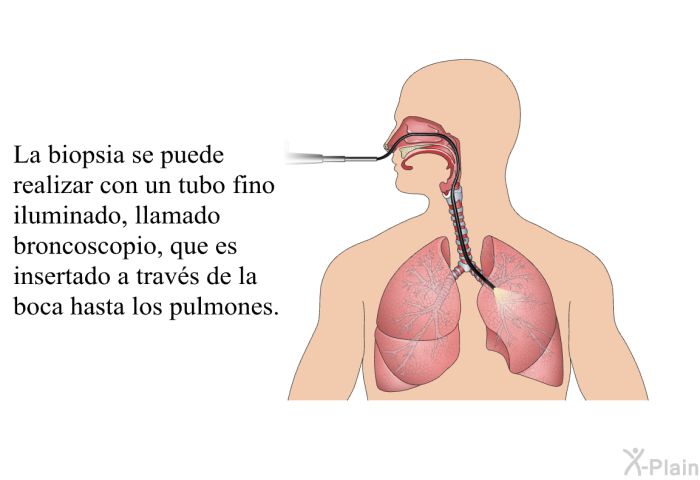 La biopsia se puede realizar con un tubo fino iluminado, llamado <I>broncoscopio</I>, que es insertado a trav�s de la boca hasta los pulmones.