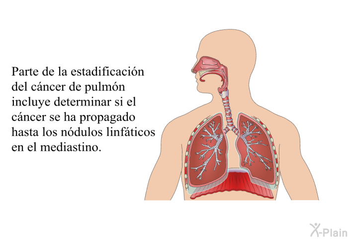 Parte de la estadificaci�n del c�ncer de pulm�n incluye determinar si el c�ncer se ha propagado hasta los n�dulos linf�ticos en el mediastino.
