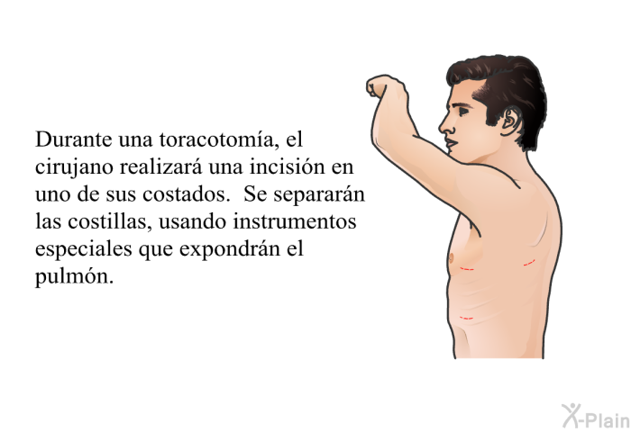 Durante una toracotoma, el cirujano realizar una incisin en uno de sus costados. Se separarn las costillas, usando instrumentos especiales que expondrn el pulmn.